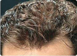 hair loss treatment brisbane