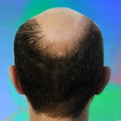 hair loss rogaine treatment